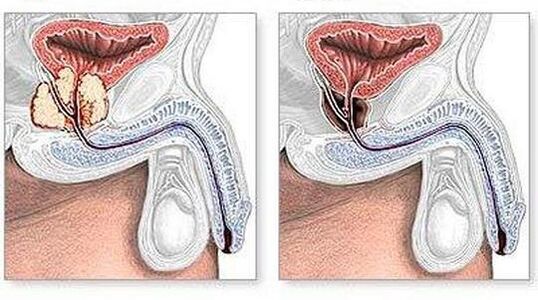 Antes e despois do tratamento da prostatite crónica cirurxicamente