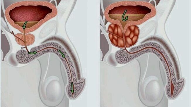 próstata sa e inflamada con prostatite