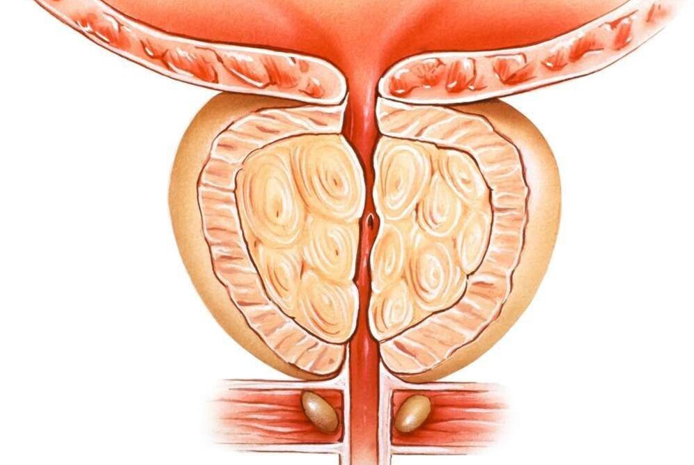 prostatite conxestiva