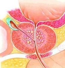 Adenoma de próstata